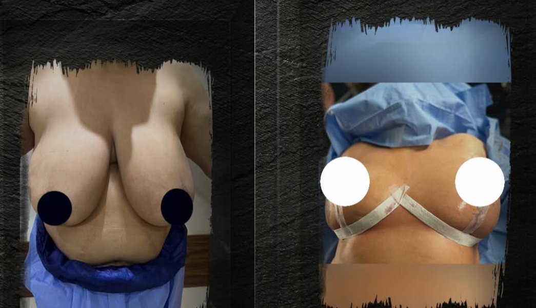 Breast Surgery Before After