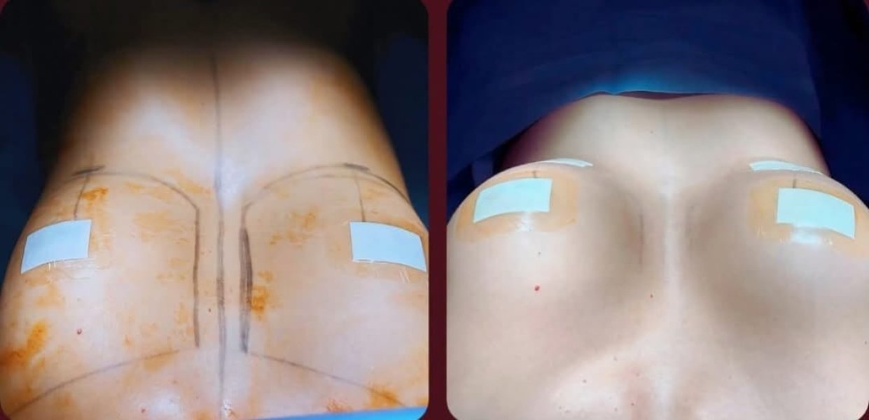 Buttock Surgery Beforeafter