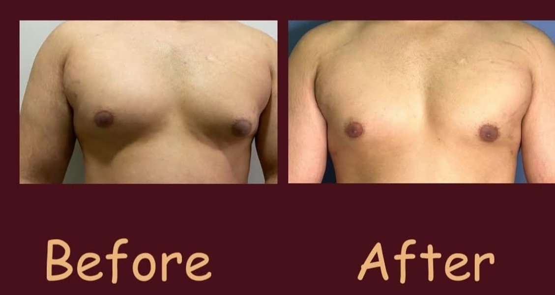 Gynecomastia Before After