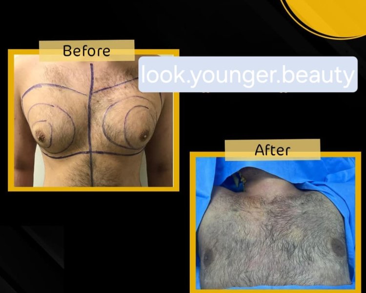 Gynecomastia Surgery Before After