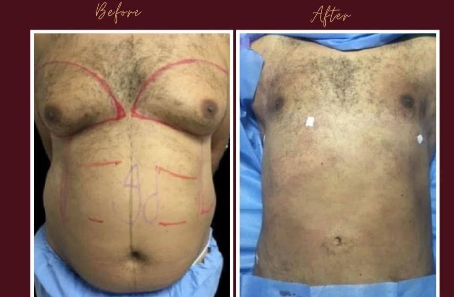 Male Torso Surgery