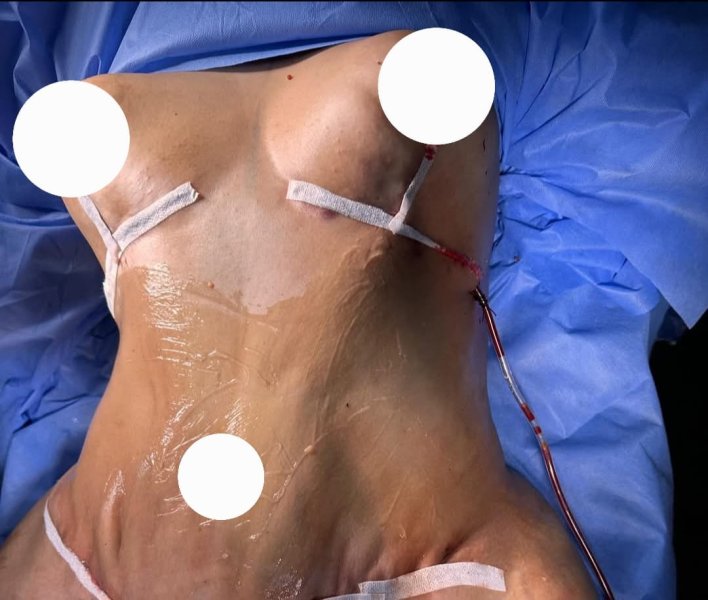 Post Op Tummy Tuck