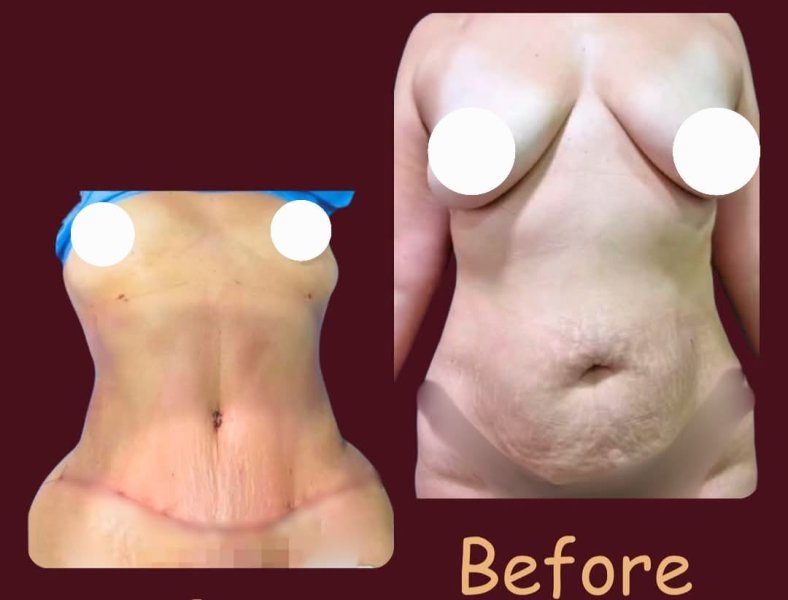 Tummy Before Surgery