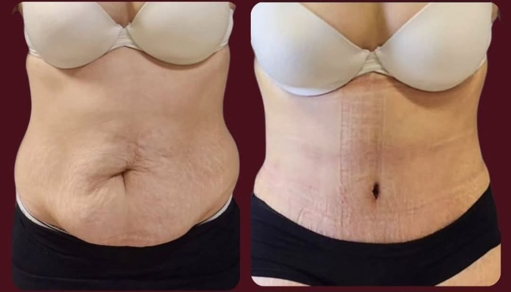 Tummy Transformation Results