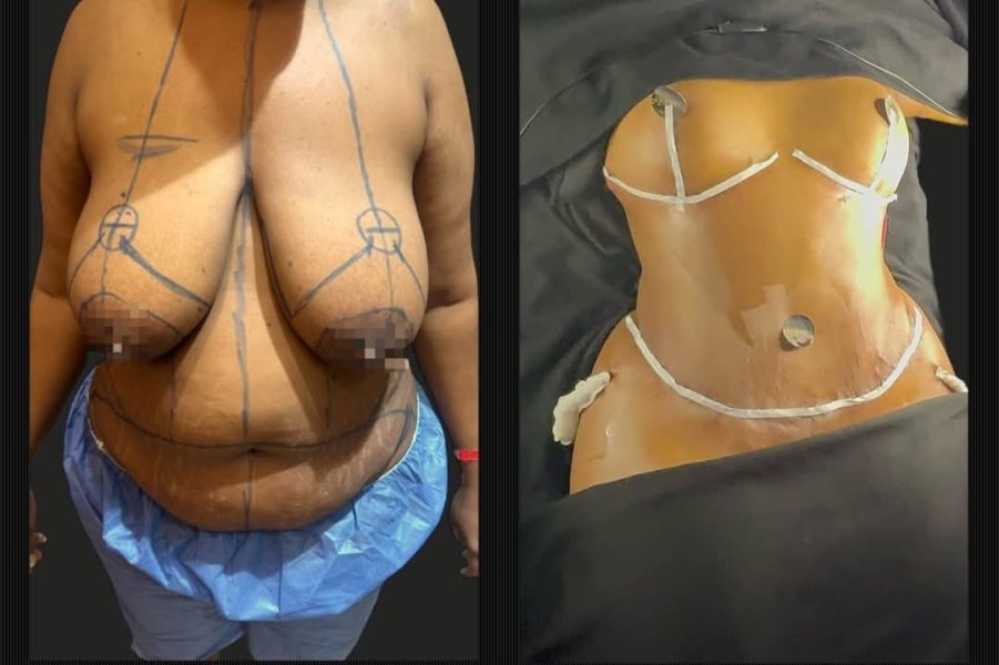Tummy Tuck Surgery
