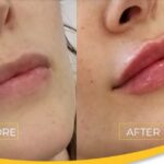 lip filler