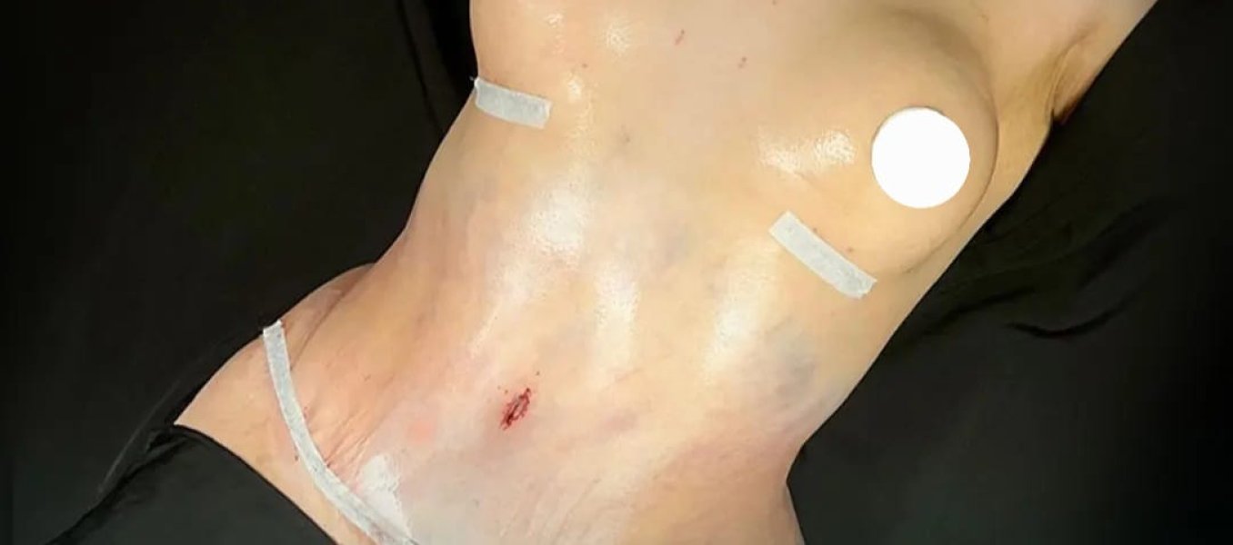 Abdominal Surgery Scars