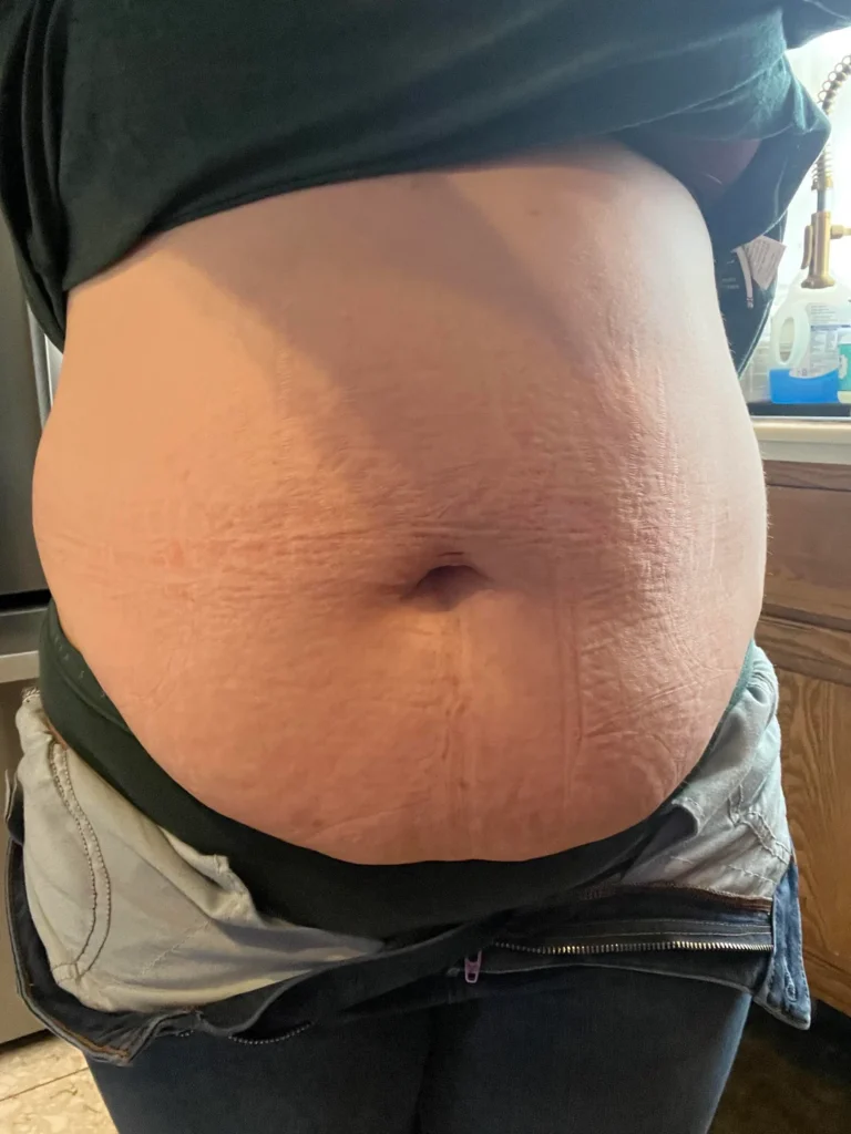 Apron Belly