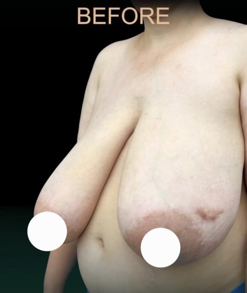Before Breast Reduction