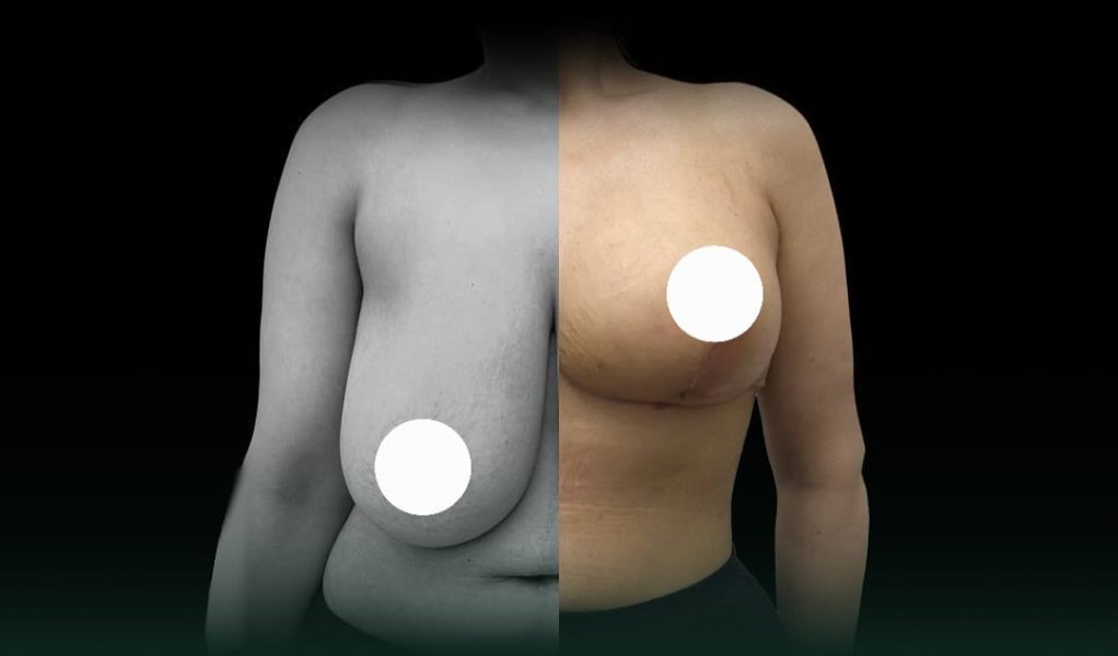 Breast Anatomy Comparison