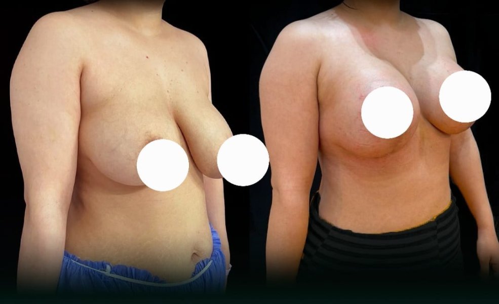 Breast Augmentation