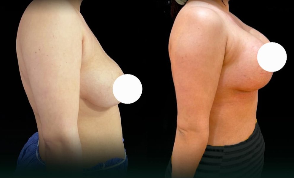 Breast Augmentation