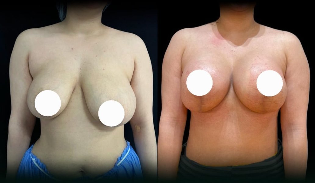 Breast Augmentation Surgery
