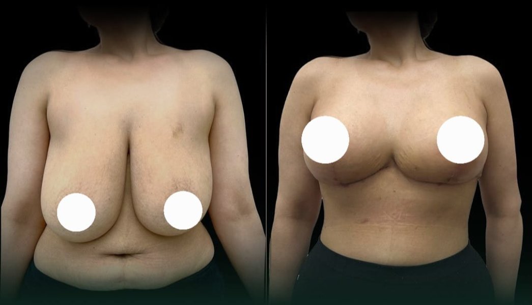 Breast Reduction Surgery
