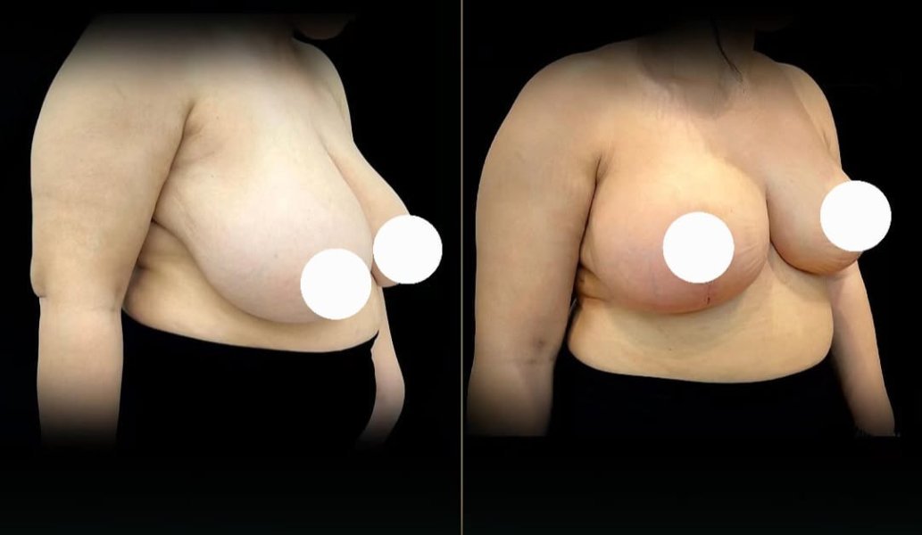 Breast Reduction Surgery