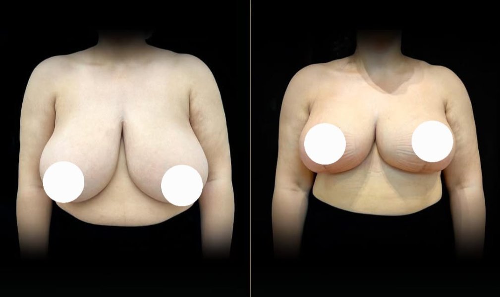 Breast Reduction Surgery
