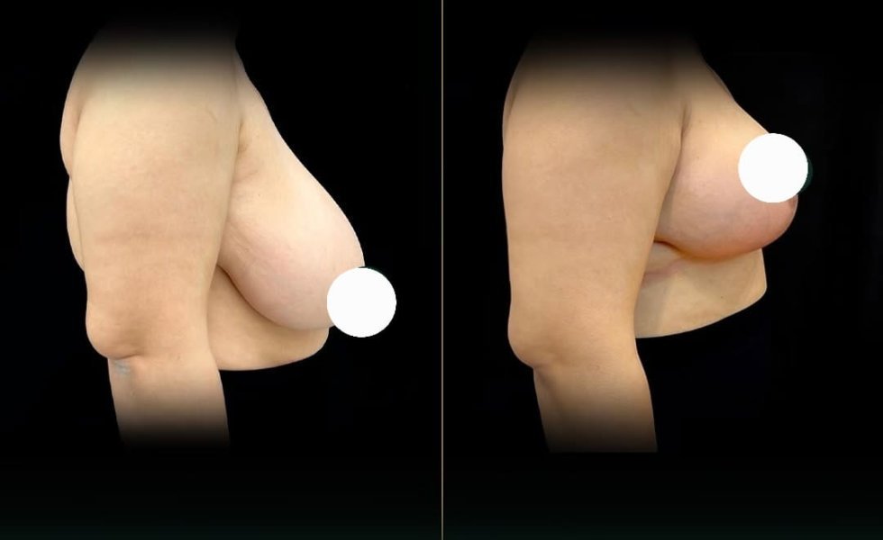 Breast Reduction Surgery
