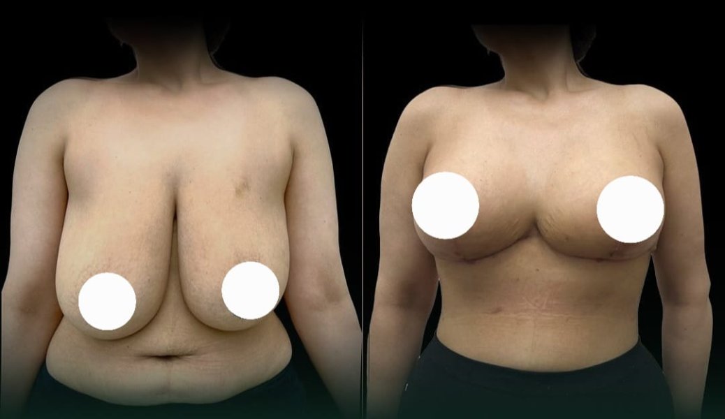 Breast Reduction Surgery