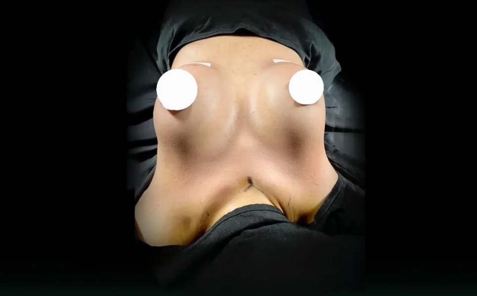 Buttocks Exposed Back