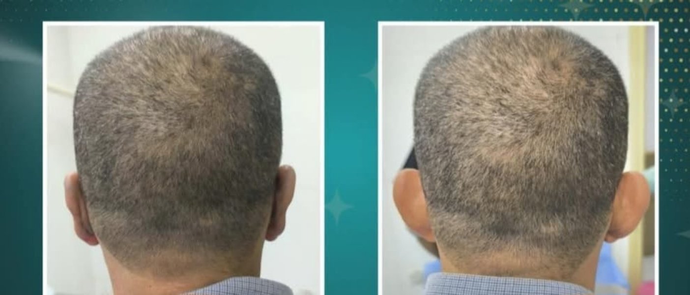 Before After Hair Transplant