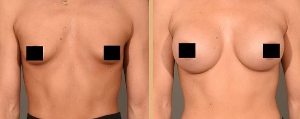 Breast Augmentation