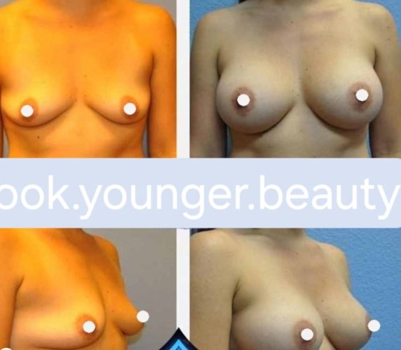 Breast Augmentation