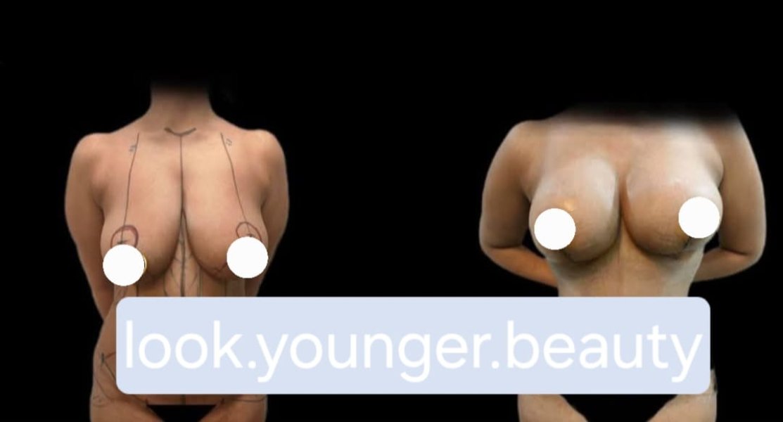 Breast Augmentation Before After