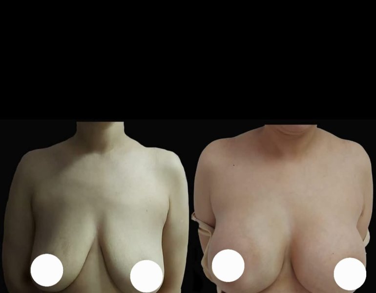 Breast Augmentation Results