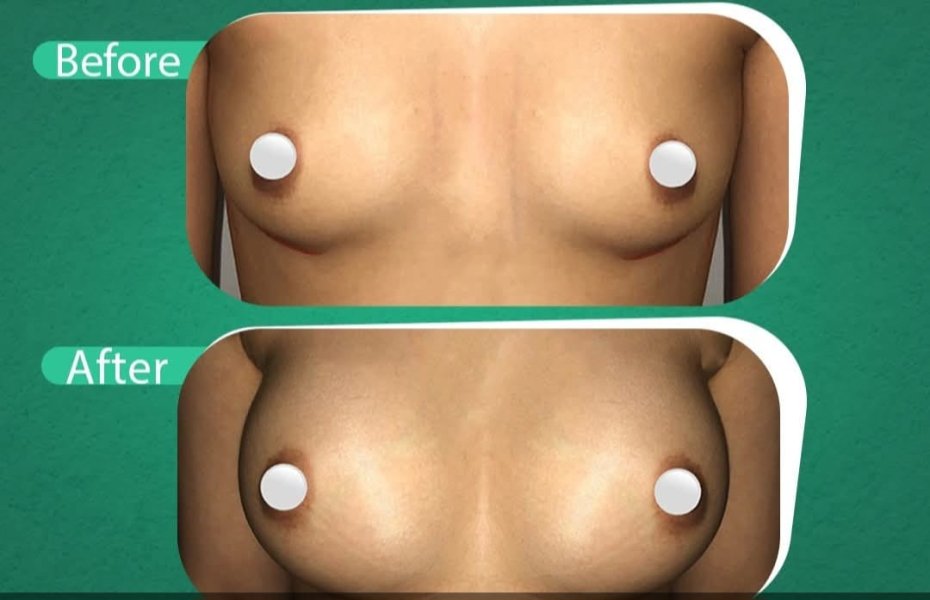 Breast Augmentation Results