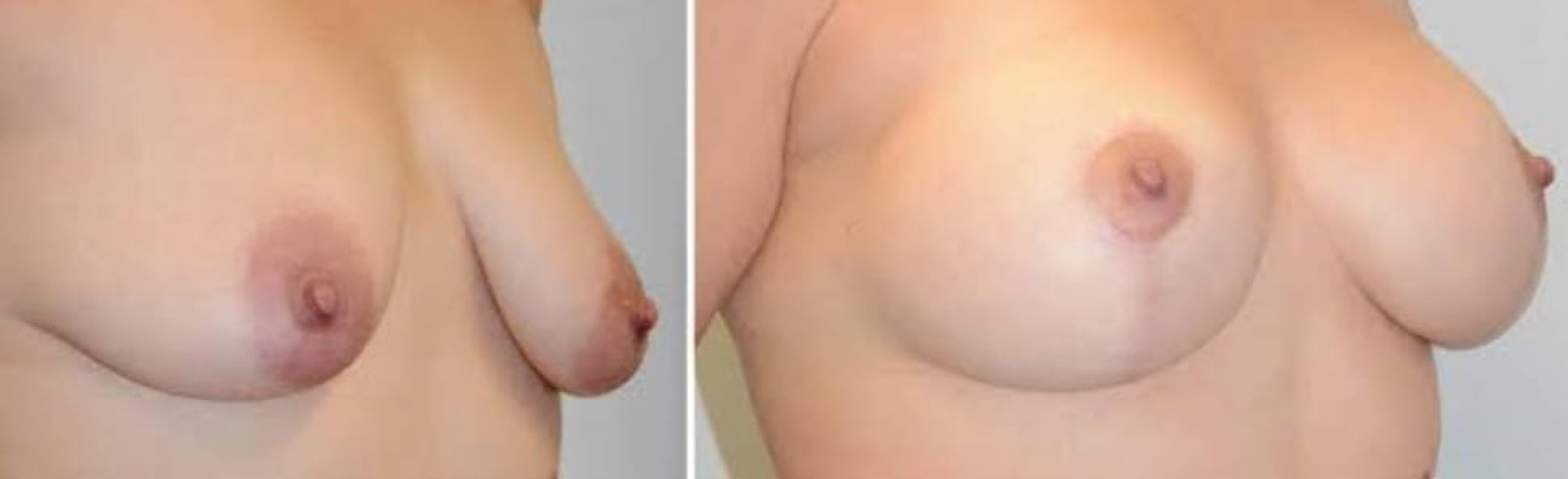 Breast Augmentation Surgery