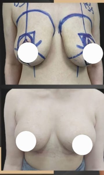 Breast Augmentation Surgery Results