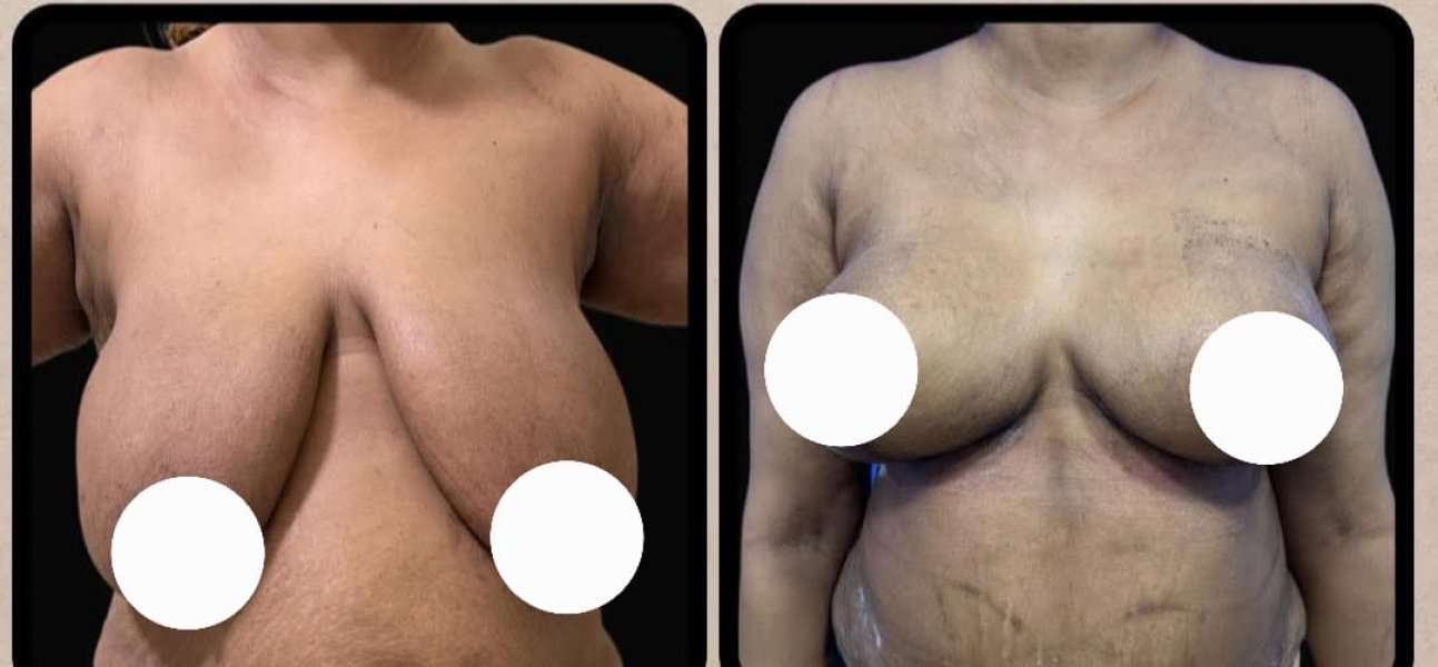 Breast Reconstruction Surgery Scars