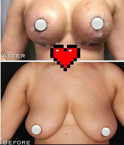 Breast Reduction Surgery