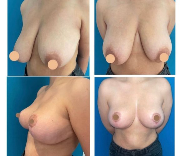 Breast Reduction Surgery