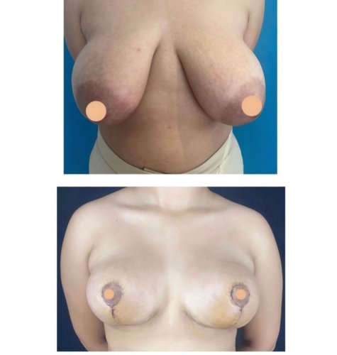 Breast Reduction Surgery