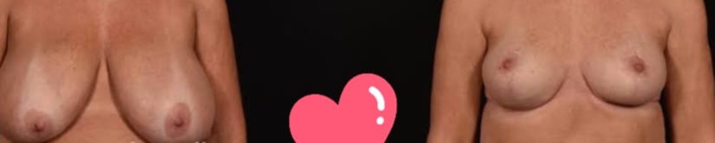 Breast Reduction Surgery