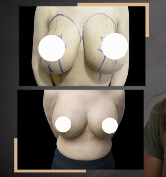 Breast Reduction Surgery Before After