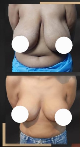 Breast Reduction Surgery Results