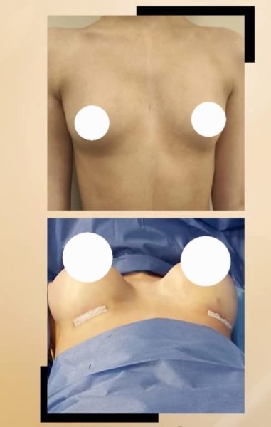 Chest Surgery Before After