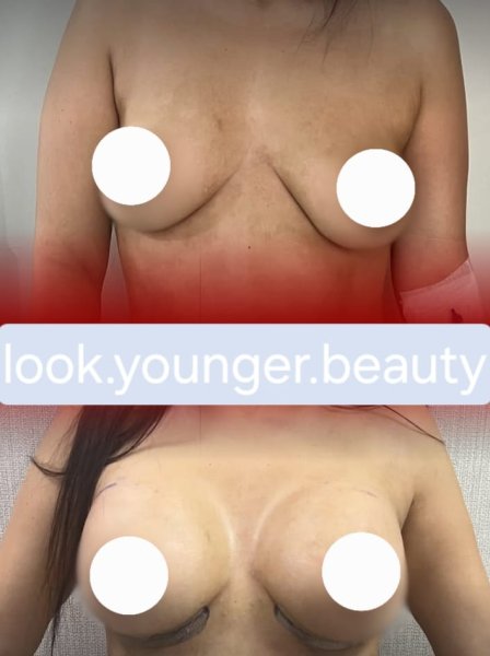 Breast Augmentation Before After