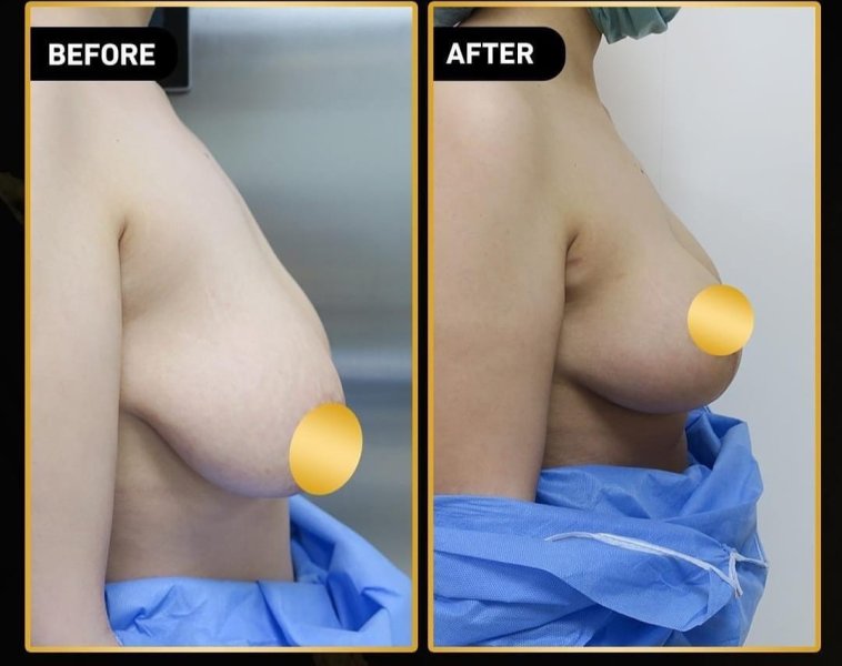 Breast Augmentation Before After