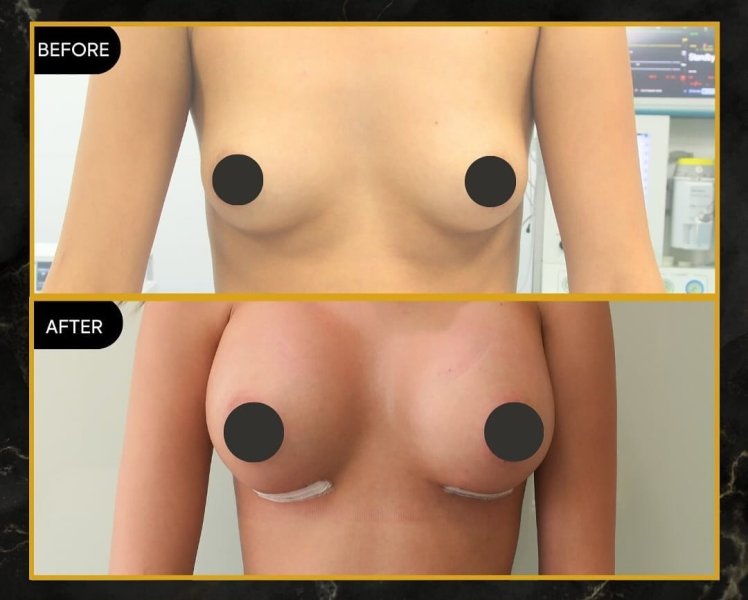 Breast Augmentation Before After