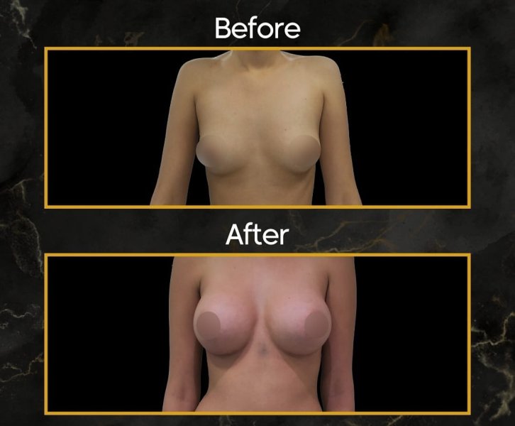 Breast Augmentation Before After