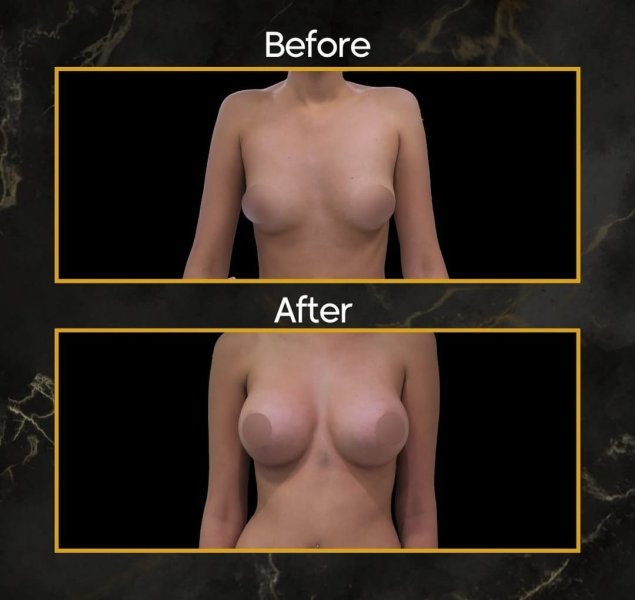 Breast Augmentation Before After