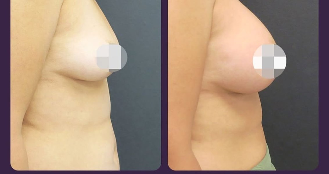 Breast Augmentation Results