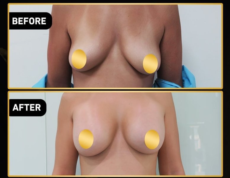 Breast Augmentation Results