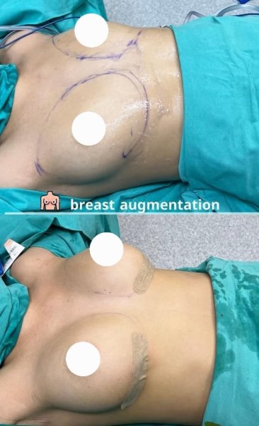 Breast Augmentation Surgery Prep