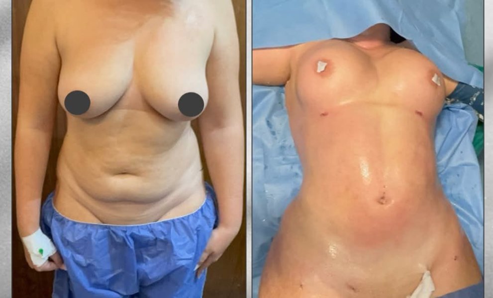 Breast Implant Removal Surgery Scars