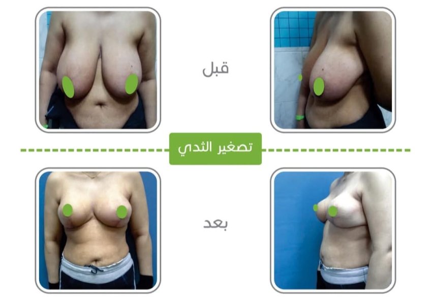 Breast Reduction Before After