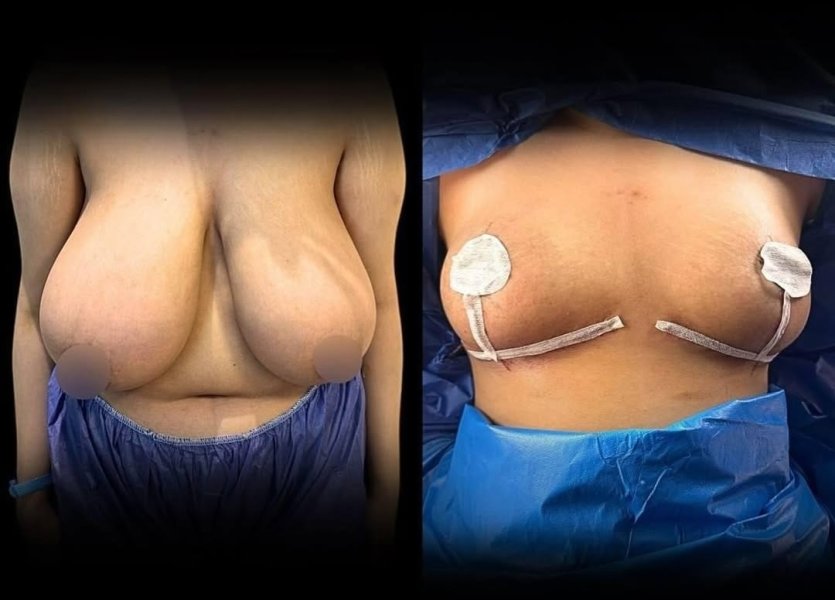Breast Reduction Surgery Before After